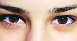 眼袋类型,脂肪型,长春好的整形医院