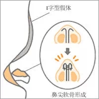 I型假体,长春好的整形医院