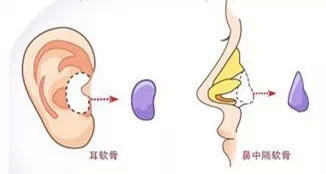 自体软骨,长春好的整形医院