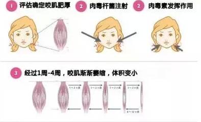 脸型,瘦脸针,长春好的整形医院