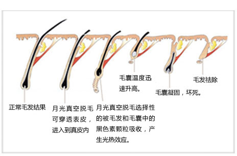 冰点脱毛,过程,长春好的整形医院