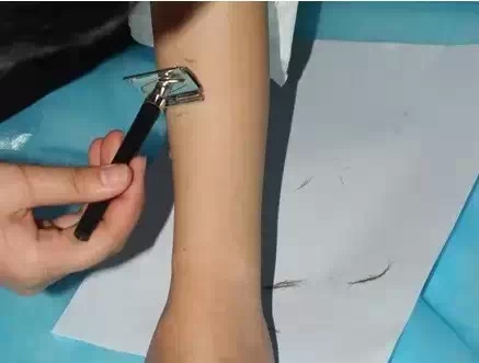 冰点脱毛,过程,长春好的整形医院