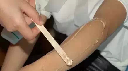 冰点脱毛,过程,长春好的整形医院