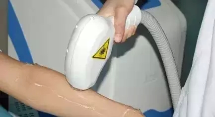 冰点脱毛,过程,长春好的整形医院