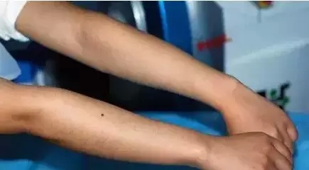 冰点脱毛,过程,长春好的整形医院