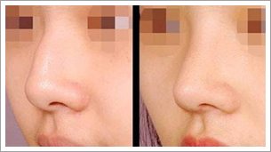 鼻尖,对比图,长春好的整形医院