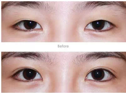 双眼皮,对比图,长春好的整形医院