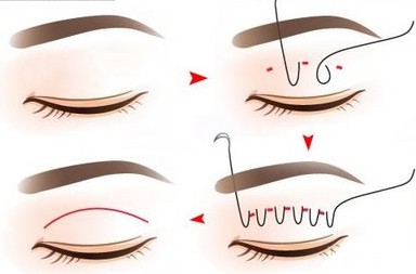 　　埋线双眼皮整形医院哪里好？埋线双眼皮以其独有的特点让众多的求美者中的一部分人对其青睐有加。埋线双眼皮不用切开皮肤和埋线后恢复快的特点让不少人都愿意选择该手术方法。那么，埋线双眼皮整形医院哪里好？下面一起来详细的了解一下。  　　埋线双眼皮整形医院哪里好？埋线双眼皮给很多求美者带来了好看的双眼皮，不少正准备做该手术的人因为整形医院太多而不知道到哪家整形医院做手术好。在此小编为大家推荐南京华美美容医院就是大家做埋线双眼皮不错的选择！下面一起来了解一下南京华美整形医院的埋线双眼皮特点。  　　一、一术多效：华美整形的埋线双眼皮手术术后获得好看的双眼皮的同时还可以解决很多求美者原本的眼部问题（例：内眦赘皮、眼轮匝肌、外眦下垂）；  　　二、术后自然：华美整形医院精细的手术操作让求美者术后消肿后可以获得美观且自然的双眼皮；  　　三、手术时间短：相比于切开双眼皮手术，华美埋线双眼皮手术一般都在30分钟以内就可以结束手术，让您轻松获得好看的双眼皮。  　　以上就是对“埋线双眼皮整形医院哪里好”的介绍，希望可以帮助到大家。如果大家需要预约华美双眼皮整形专家，欢迎咨询在线的整形专家进行免费预约挂号。