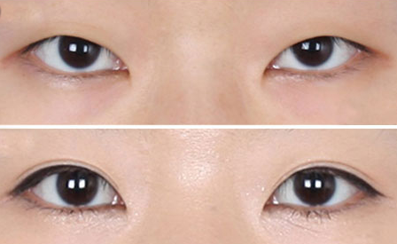 长春双眼皮,铭医双眼皮,双眼皮哪里好