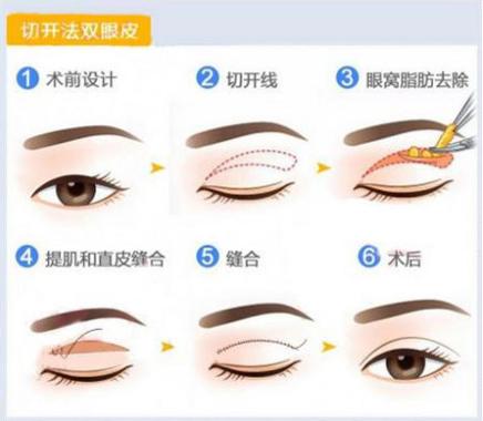 长春双眼皮,双眼皮哪里好,铭医双眼皮