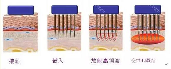 长春水光针,水光针哪里好,水光针价格