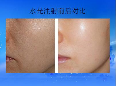 长春水光针,水光针哪里好,水光针价格