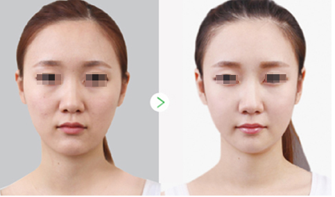 长春水光针,水光针哪里好,水光针价格