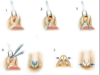 长春隆鼻,达拉斯隆鼻,长春做鼻子