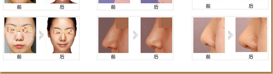 长春隆鼻,达拉斯隆鼻,长春做鼻子