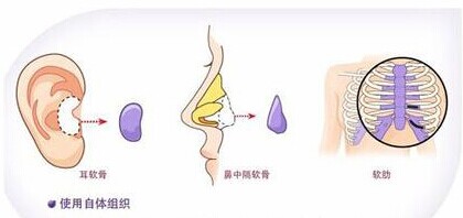 长春隆鼻,达拉斯隆鼻,长春做鼻子