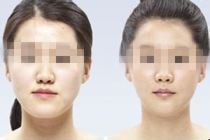 瘦脸对比图,长春铭医