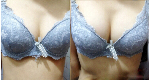 隆胸对比图