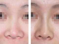 隆鼻对比图