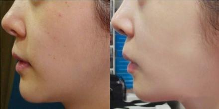 水光针效果对比