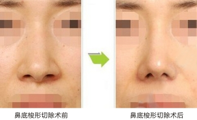 鼻翼缩小对比