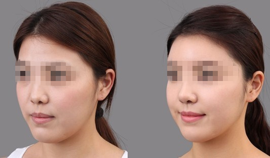 鼻尖整形,假体隆鼻,鼻整形