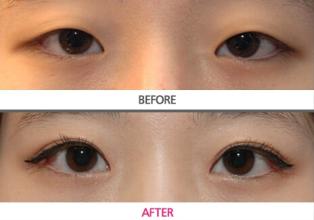 长春双眼皮,铭医双眼皮