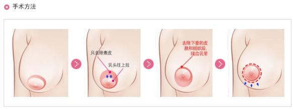 乳房下垂矫正,除皱,水动力吸脂