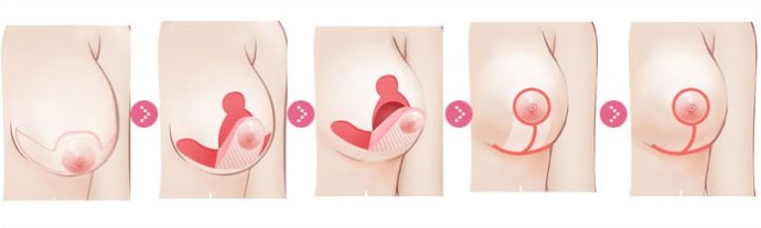 长春铭医,产后胸部下垂