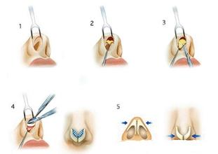 隆鼻,高度,专家