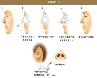 隆鼻,材料,专家