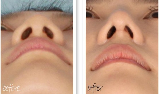 吉林铭医膨体隆鼻对比图,膨体隆鼻,吉林铭医,长春隆鼻