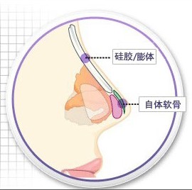 注射隆鼻、假体隆鼻：大对比