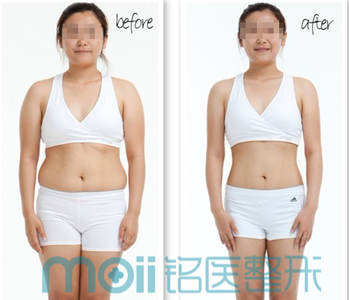 水动力吸脂,腰,腹,对比图,长春好的整形医院