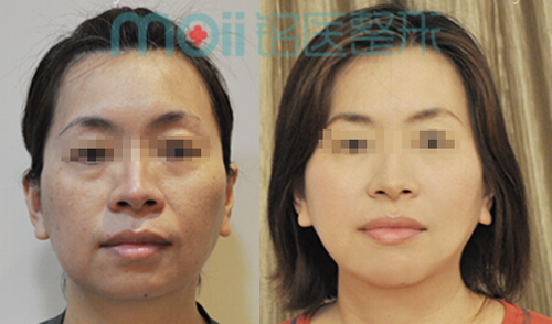 电波拉皮,对比图,长春好的整形医院