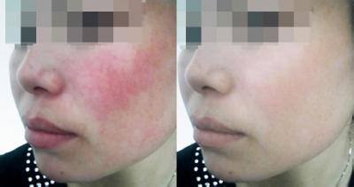 除红血丝,对比图,长春好的整形医院