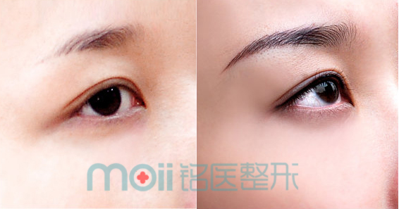 文眉,对比图,长春好的整形医院