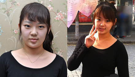 长春除皱,长春瘦脸