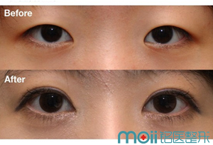 长春双眼皮,开眼角,对比图,长春好的整形医院