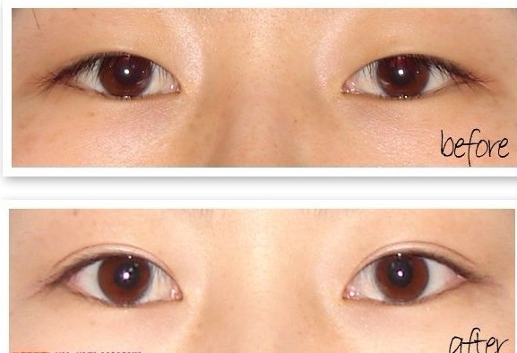 长春双眼皮,开眼角,对比图,长春好的整形医院