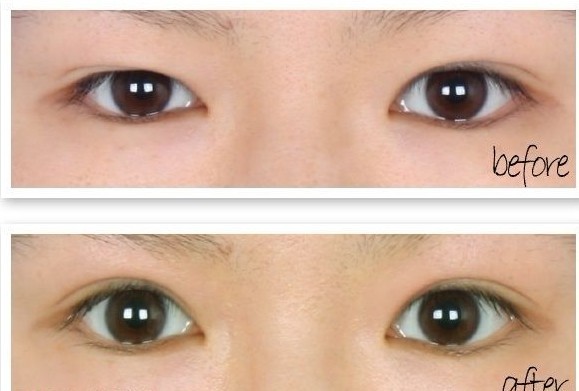 长春双眼皮,开眼角,对比图,长春好的整形医院