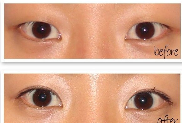 长春双眼皮,开眼角,对比图,长春好的整形医院
