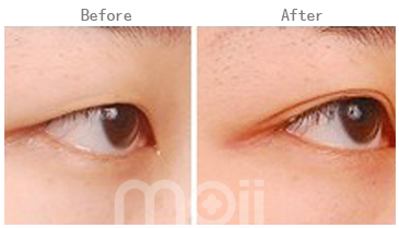 长春双眼皮,开眼角,对比图,长春好的整形医院