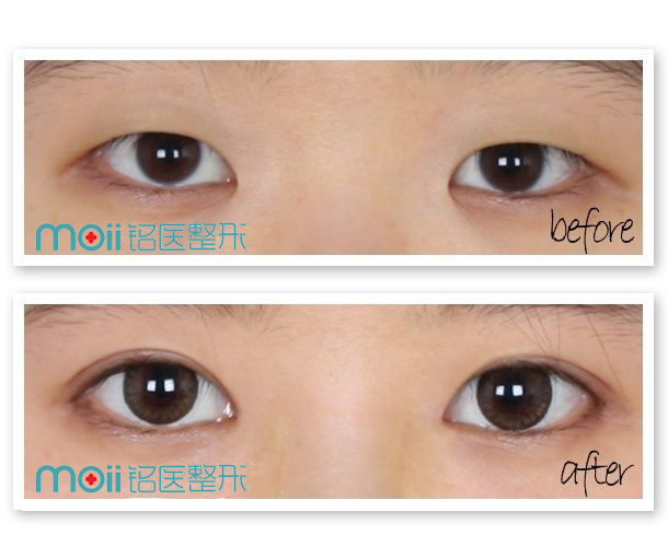 长春双眼皮,开眼角,对比图,长春好的整形医院
