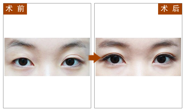 双眼皮,对比图,长春好的整形医院