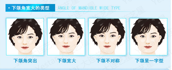 下颌角,对比图,长春好的整形医院