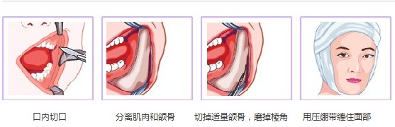 下颌角,手术过程,长春好的整形医院