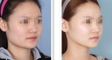 改脸型,对比图,长春好的整形医院