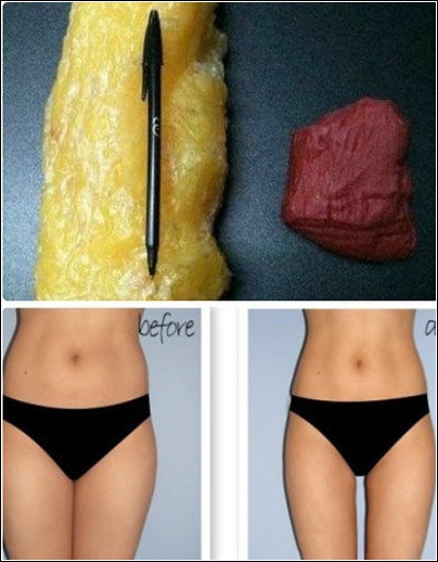 水动力,吸脂,对比图,长春好的整形医院