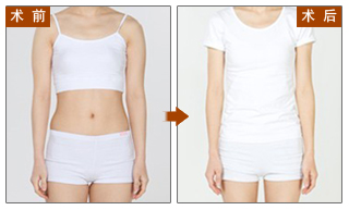 水动力,吸脂,对比图,长春好的整形医院